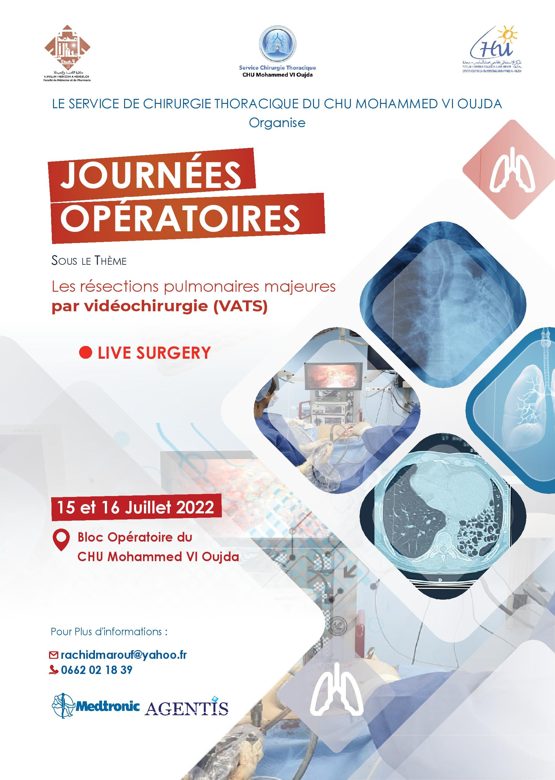 JOURNÉES OPÉRATOIRES: Les résections pulmonaires majeures par vidéochirurgie (VATS)